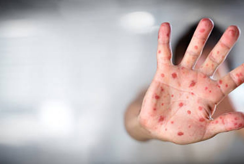 Measles Outbreak: Symptoms and Vaccine Information for Children and Adults
